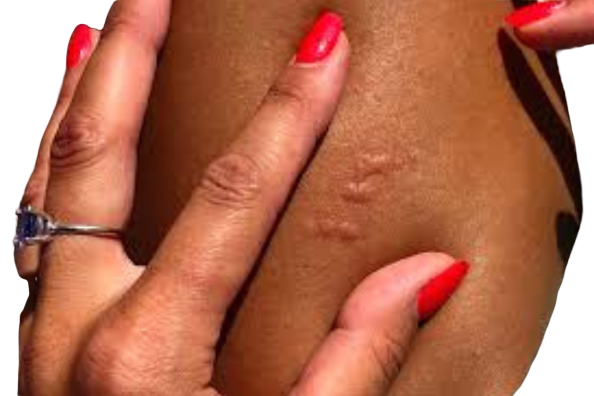 Signs of bed bug infestation